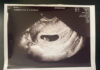 trudna-vec-sest-nedelja:-rijaliti-par-cuo-prve-otkucaje-srca-bebe
