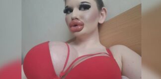 bugarska-barbika-se-pozalila-medijima:-“postoji-rizik-sljepila-i-da-mi-amputiraju-usne!”